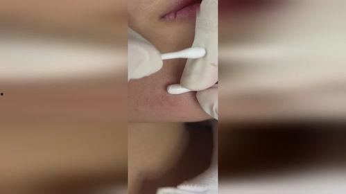 挤座疮视频,揭秘公共场所座椅卫生隐患